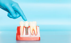 austin dental implants