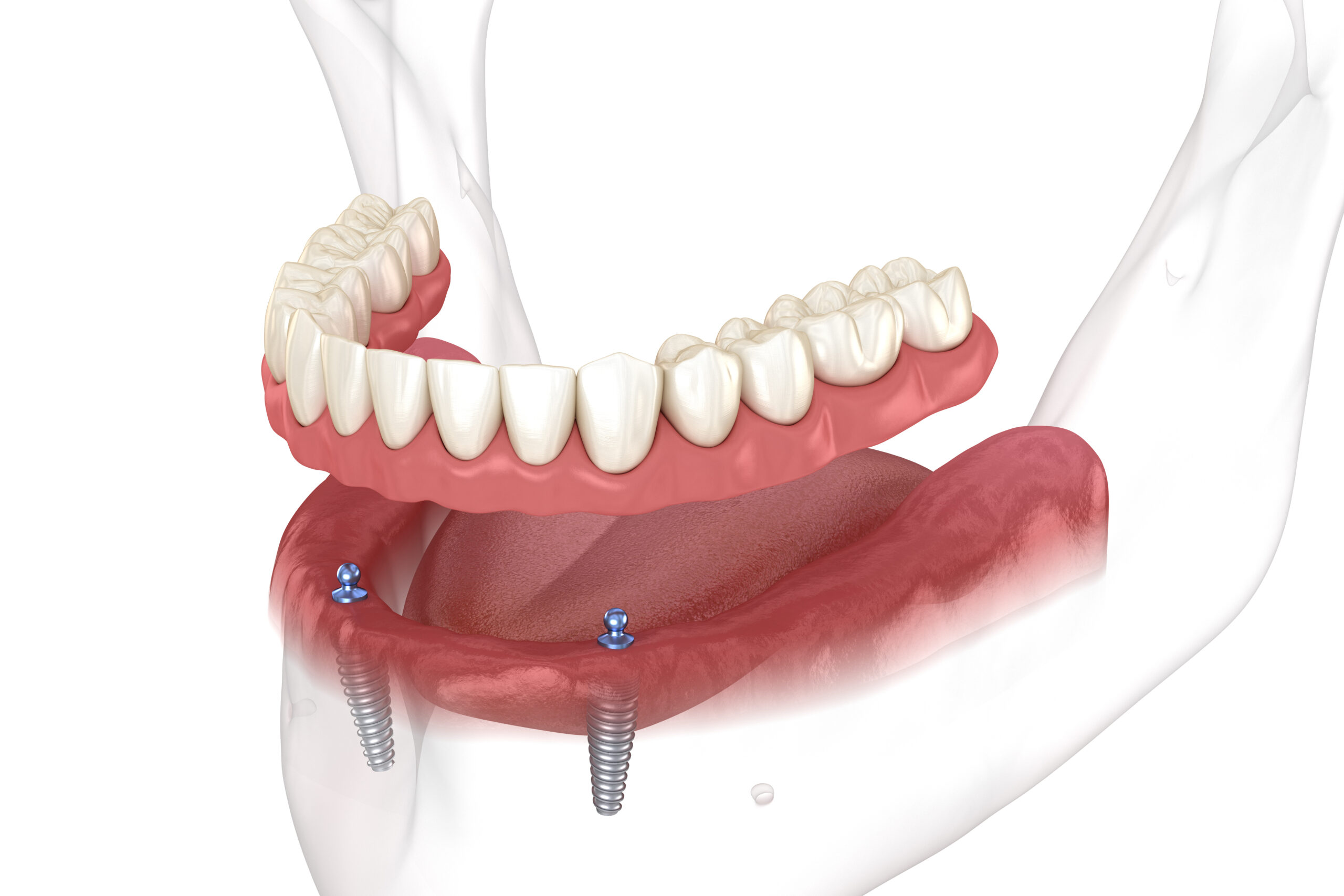 Austin dental implants