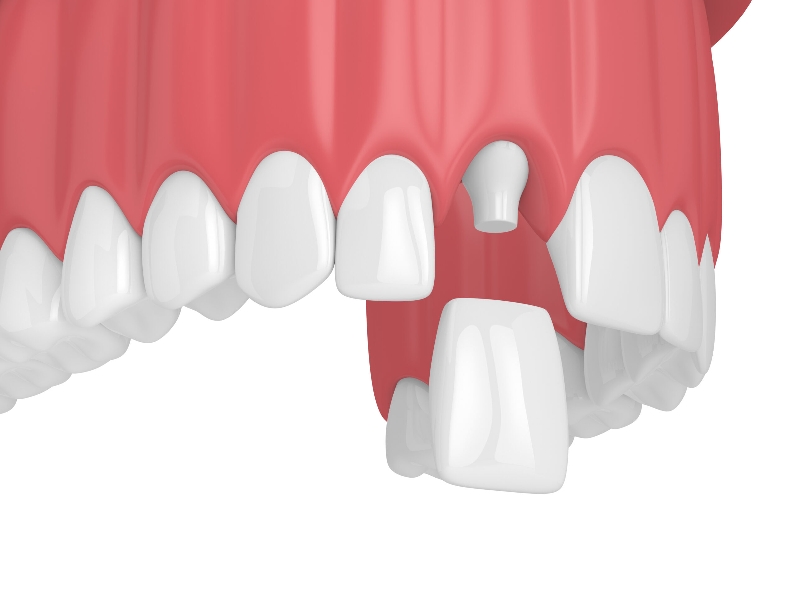austin dental crown