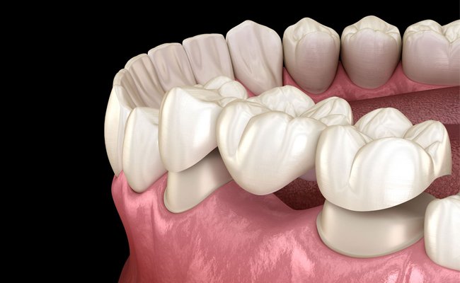 3D dental illustration showing tooth replacement options with implants and crowns on gum model.