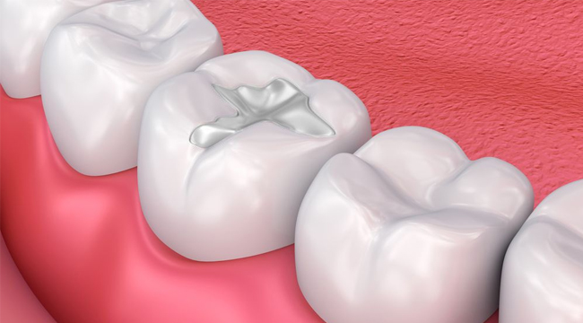 Close-up of dental fillings on molars showing restorative dentistry work on red gum background.