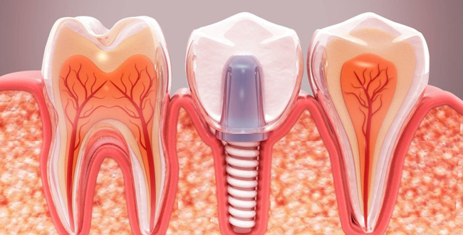 Dental implant diagram showing cross-section of tooth structure with prosthetic implant between natural teeth.