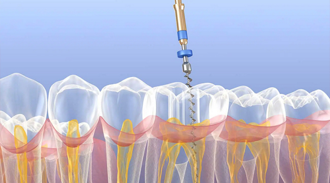 Dental implant extraction tool positioning over teeth cross-section model demonstrating surgical procedure.